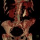 Staghorn calculus, casting stone, nephrolithiasis, VRT: CT - Computed tomography